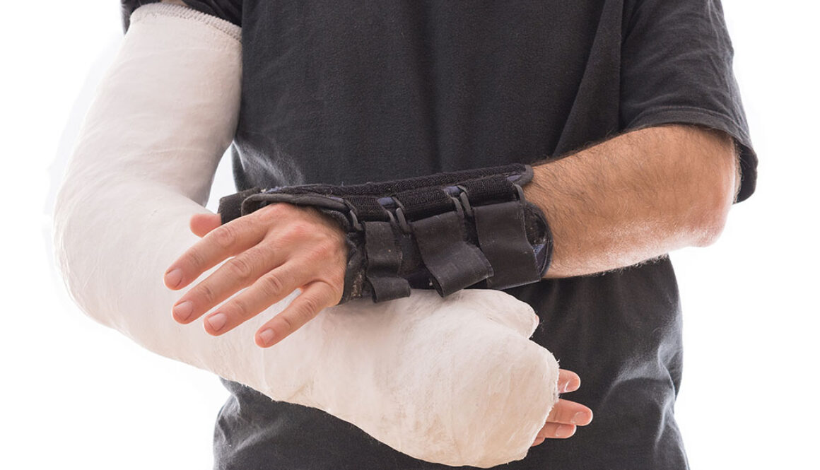 Closeup of a Man Wearing a Splint on One Hand and a Full Arm Cast on the Other Hand Splint vs Cast