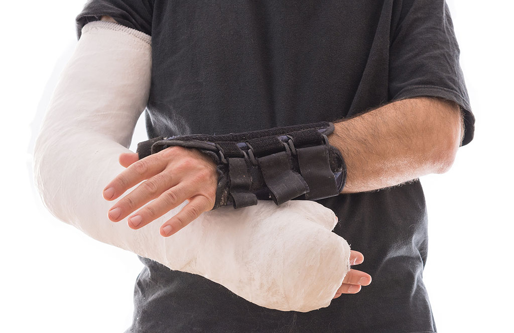 Closeup of a Man Wearing a Splint on One Hand and a Full Arm Cast on the Other Hand Splint vs Cast