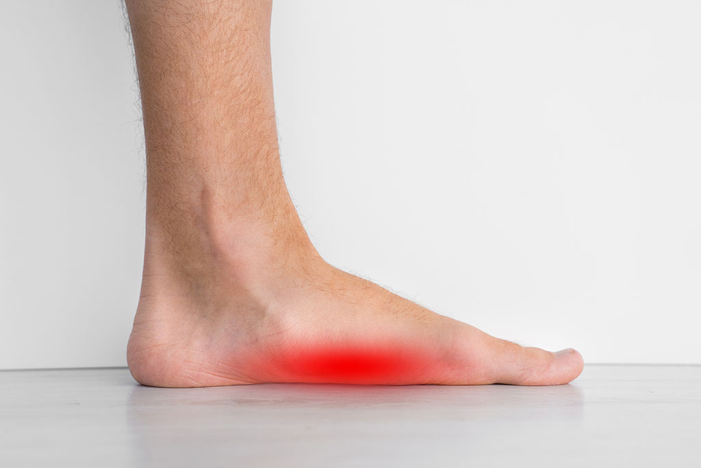 Closeup Of A Foot That Is Flat With A Red Area Highlighting Foot Pain From Flat Feet