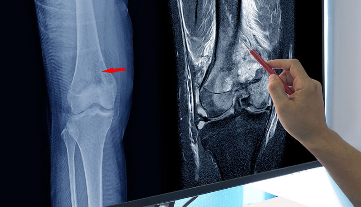 A Orthopedic Doctor Pointing To An Image On A Computer Screen Showing An MRI Vs X-Ray Of A Patient's Knee