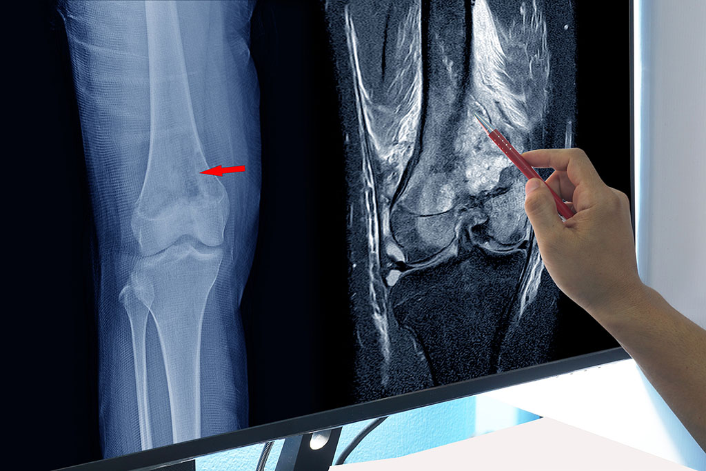 A Orthopedic Doctor Pointing To An Image On A Computer Screen Showing An MRI Vs X-Ray Of A Patient's Knee